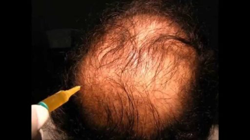 prp-alopecia-4