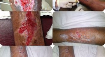 heridas1