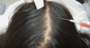 plasma-rico-en-plaquetas-alopecia